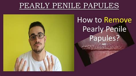 papule perlee penis|PPP: Pearly Penile Papules Facts and Treatment